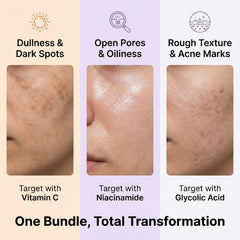 Spotless Glow Deal – 3-Step Serum Kit for Acne Marks, Pores & Brightening